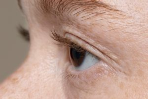 ptosis