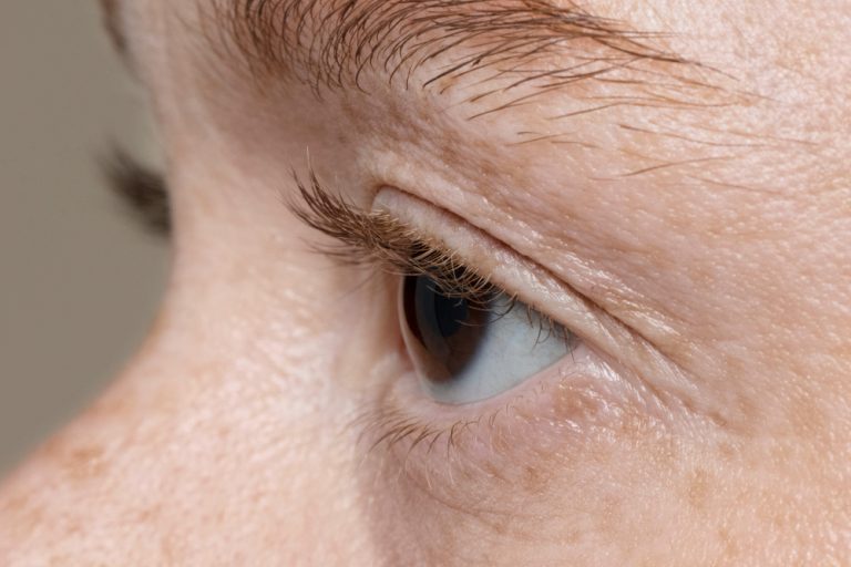 ptosis